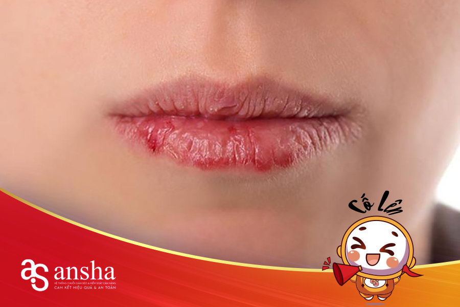 Khô miệng dẫn đến khô môi cũng là dấu hiệu đường máu cao